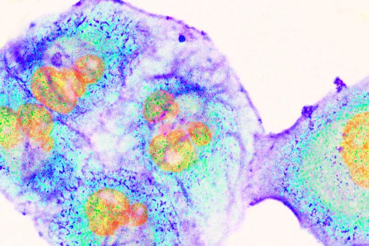 Pancreatic Cancer cells