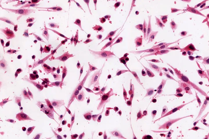 Brain Cancer cells