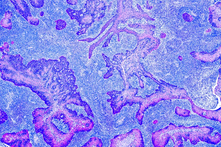 Cancer Control - web graphic