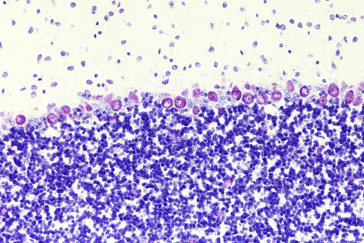 Cerebellar Ataxia - brain cells