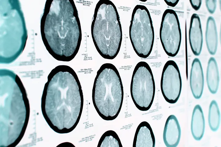 Epilepsy - web graphic