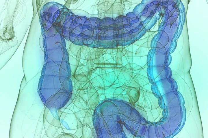 Inflammatory Bowel Disease