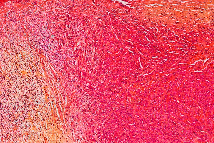 Melanoma and Other Skin Cancers - web graphic