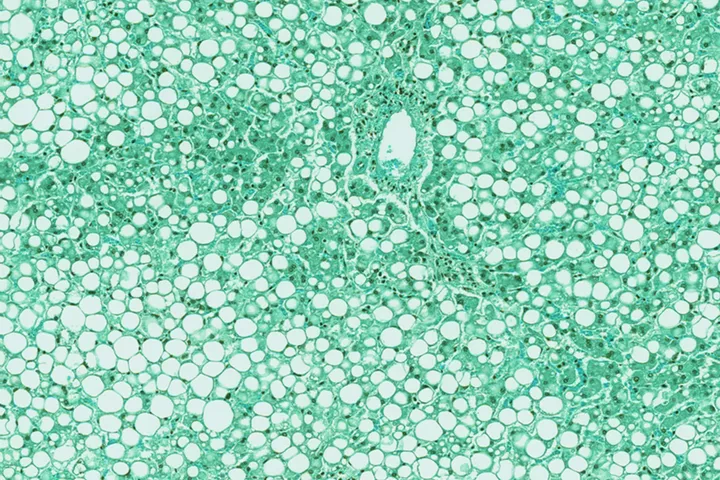 Liver Cancer - web graphic