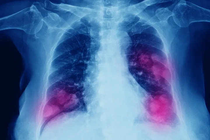 Lung Cancer and Mesothelioma - web graphic