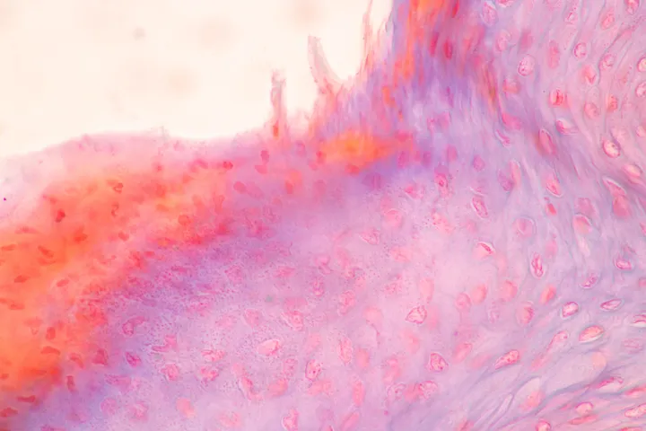 Inflamed lung tissue
