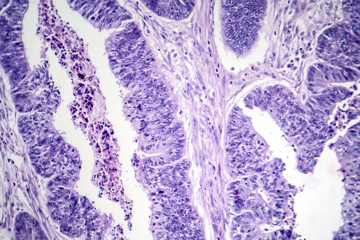 Oesophageal Cancer Web Graphic