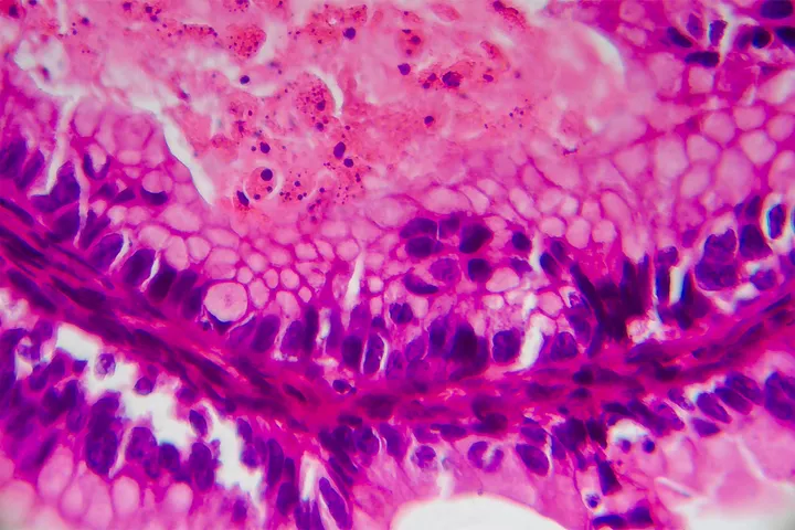Ovarian cancer