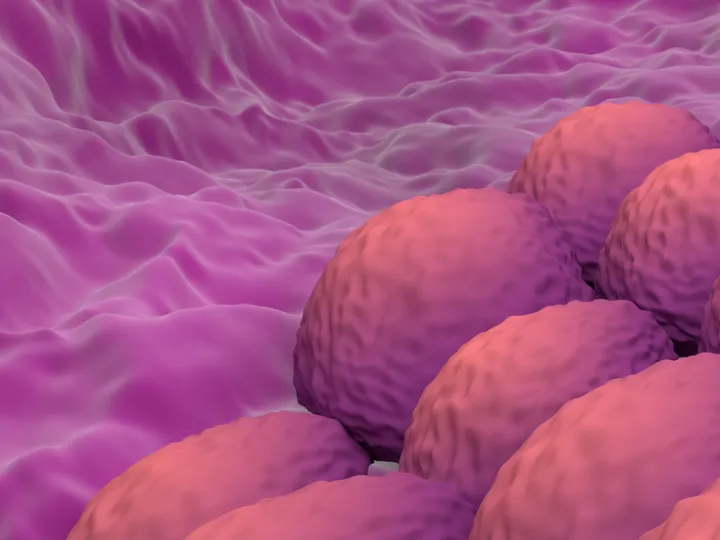 Endometrial cancer - web graphic