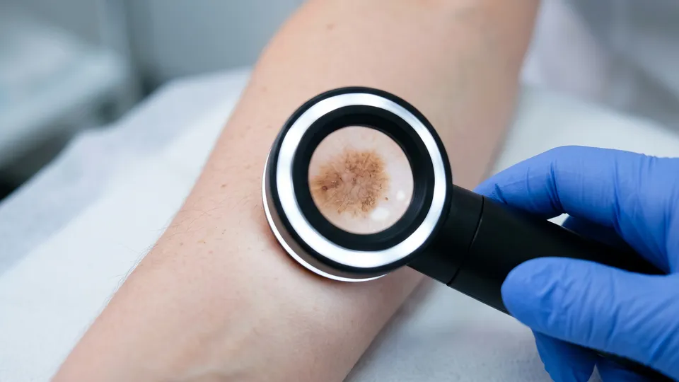 World’s largest genetic study of ‘moliness’ helps unravel mysteries of melanoma