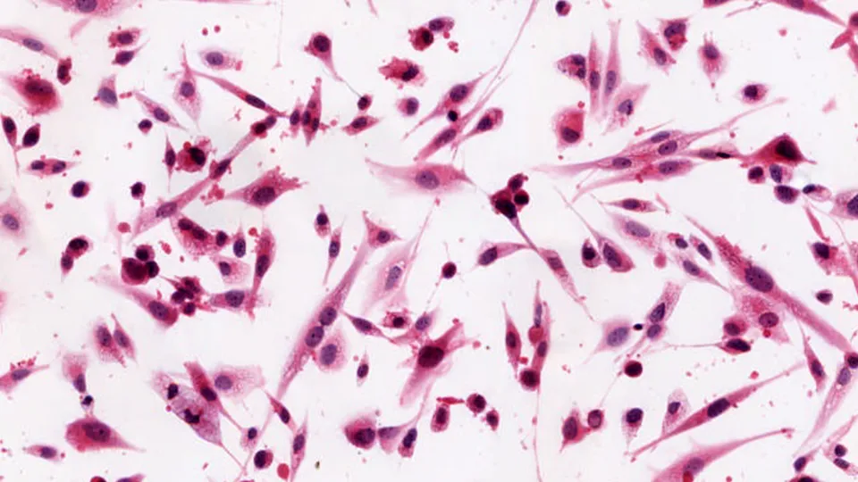 Brain Cancer cells