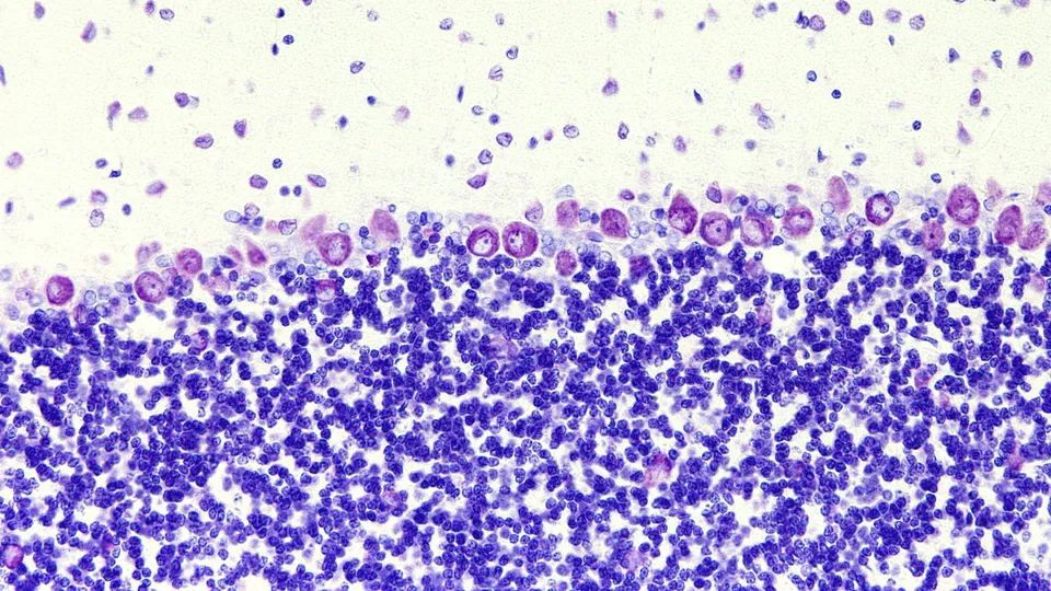 Cerebellar Ataxia - brain cells
