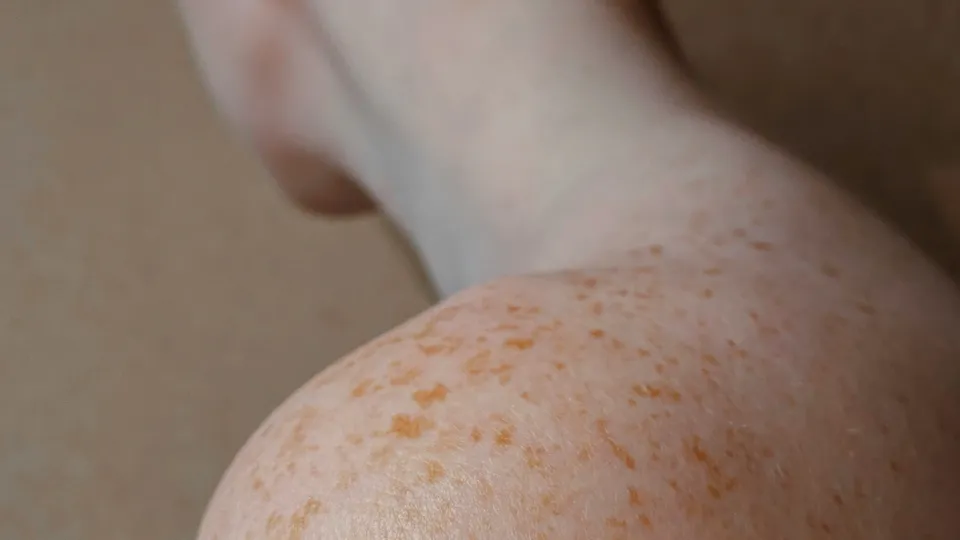 QIMRB-skin-cancer