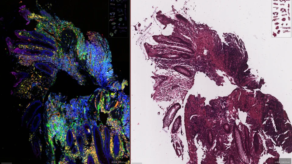 AI screening tool gives pathologists ‘spatial super vision’ to detect hidden cancer
