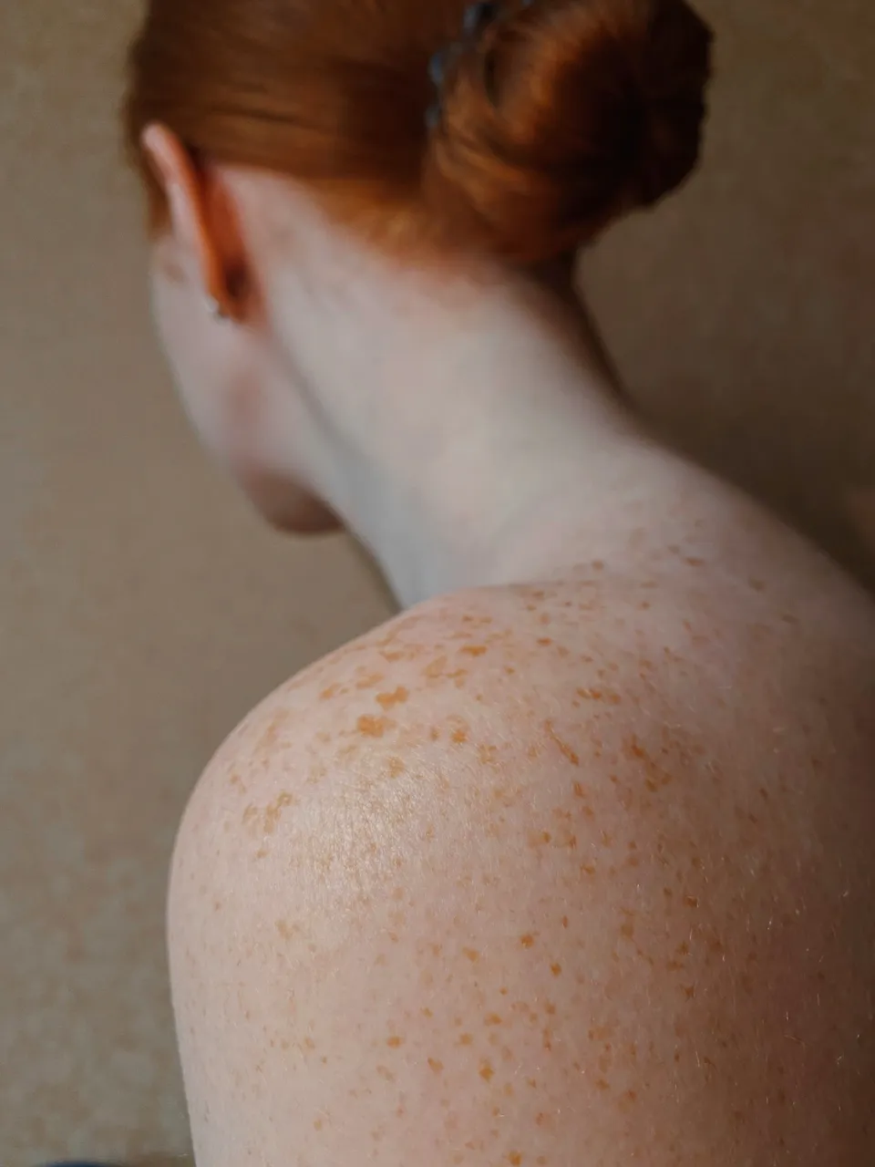 QIMRB-skin-cancer
